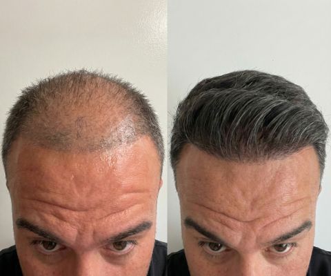 Сравнение роста волос до и после