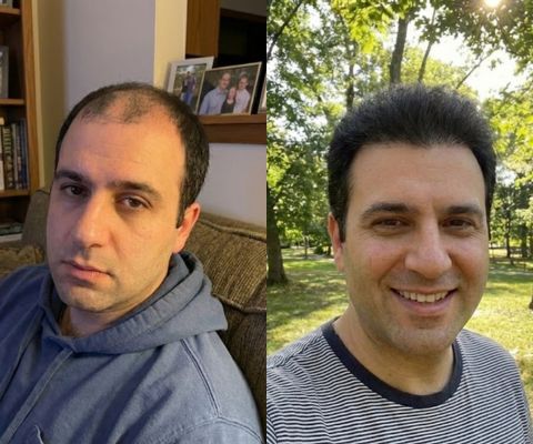 Сравнение роста волос до и после