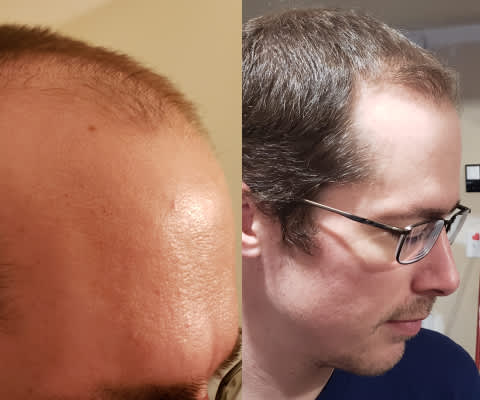 Сравнение роста волос до и после